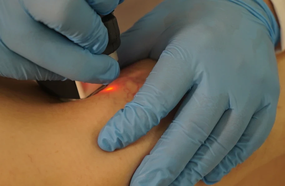 фотография лазерного удаления сосудистых звездочек в клинике Варикоза нет в Калуге