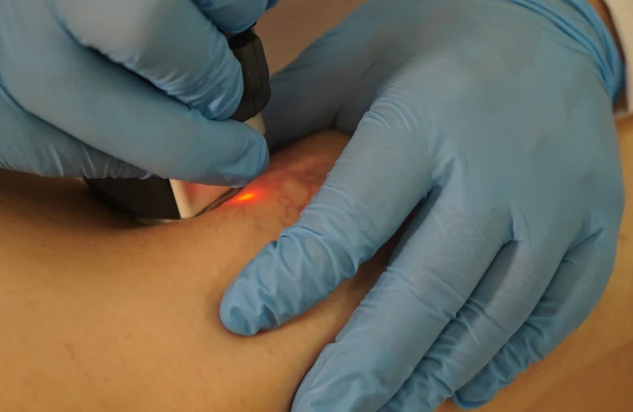 фотография лазерного удаления сосудистых звездочек в клинике Варикоза нет в Калуге